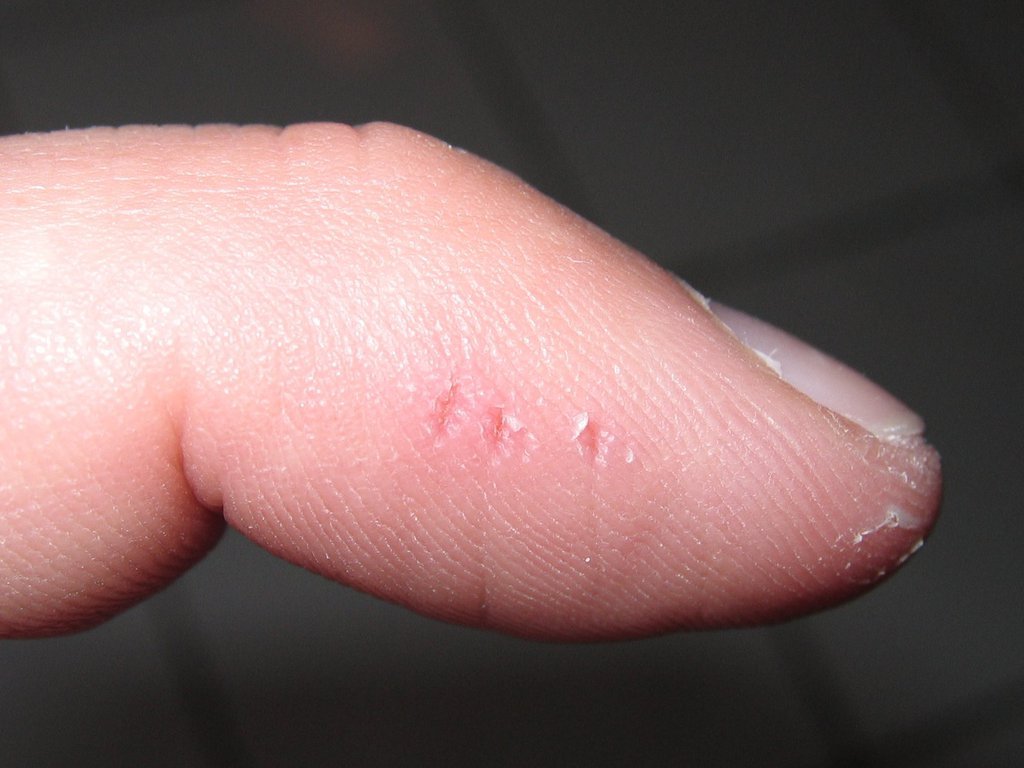 Iguana bite